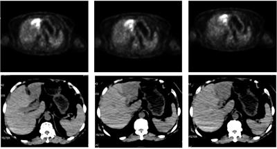 Multiple primary malignant neoplasm: Case report and comprehensive literature review